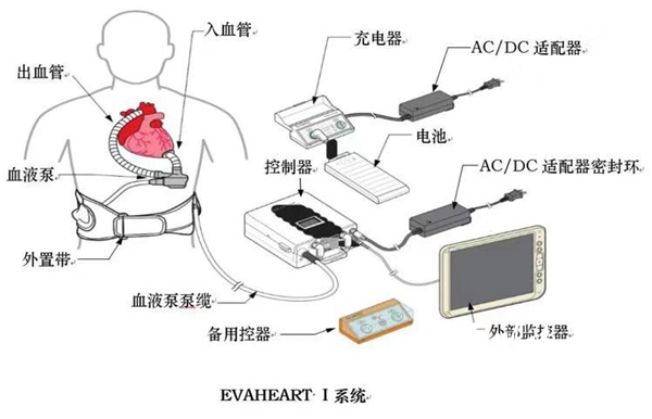 福建省心衰病人可植入免费人工心脏